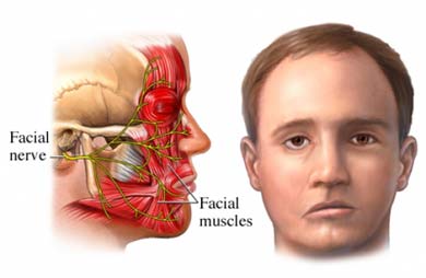 Paraliza faciale ose paraliza e fytyrës